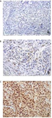 Progesterone Receptor Expression in Meningiomas: Pathological and Prognostic Implications